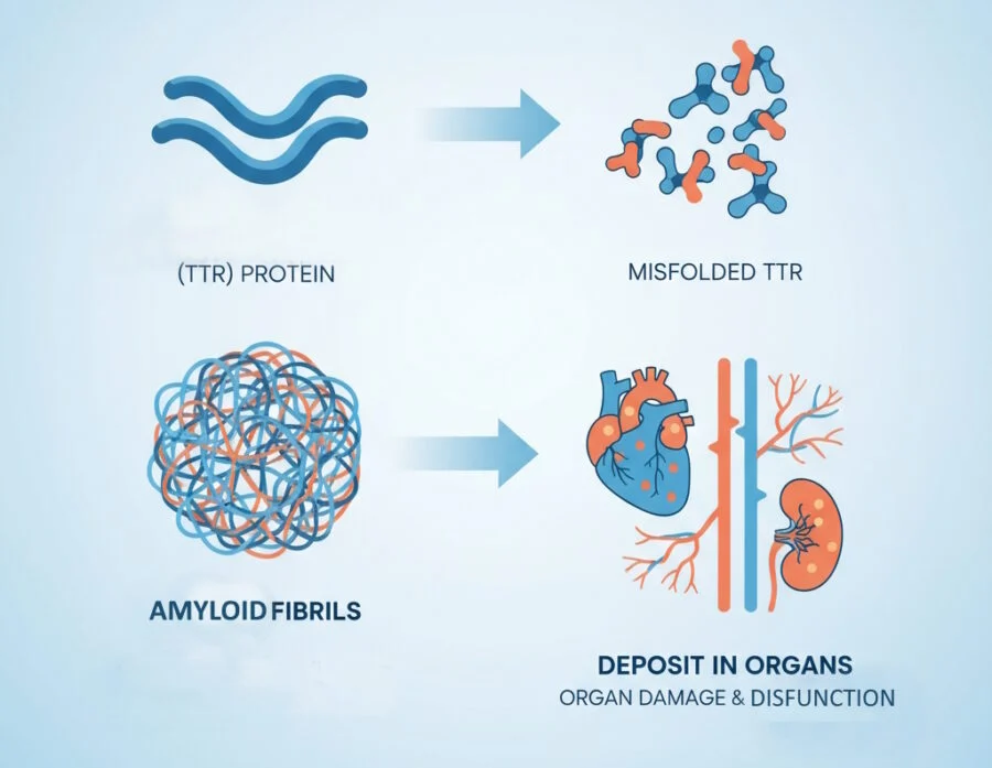 ATTR-amyloidosis how it happens