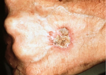 Endophytic Squamous Cell Carcinoma